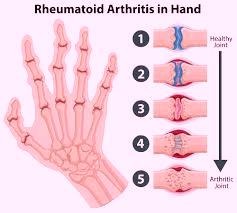 World Arthritis Day: Lasting relief requires identifying the root cause of the pain rather than merely suppressing it